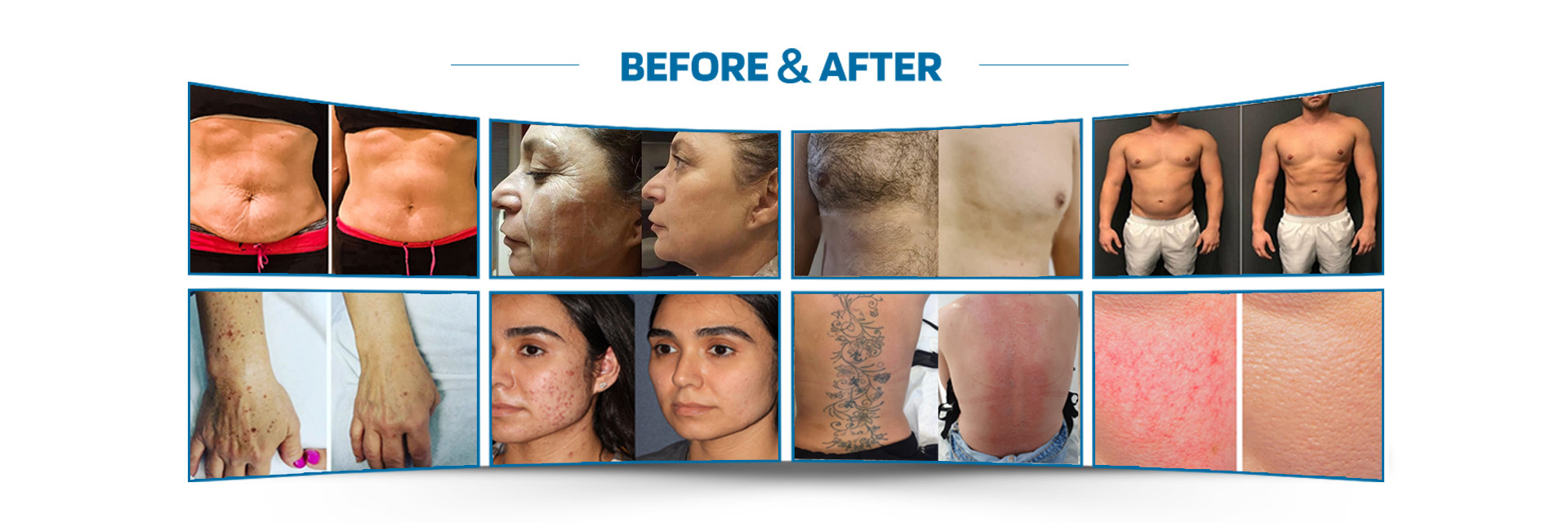 calidad Máquina del retiro del pelo del laser fábrica