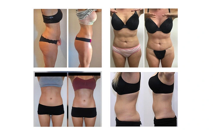 Máquina de liposucción con liposucción láser de 6D con 635nm 650nm 780nm 810nm 940nm 980nm 6