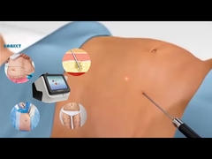 Equipo Lipo láser 30W 60W 980nm Diodo Lipo Máquina láser para la pérdida de peso