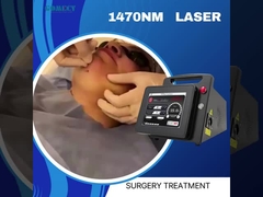 Endolaser 1470 Lifting Lipólisis facial Extirpación de la vena araña con láser endovenoso